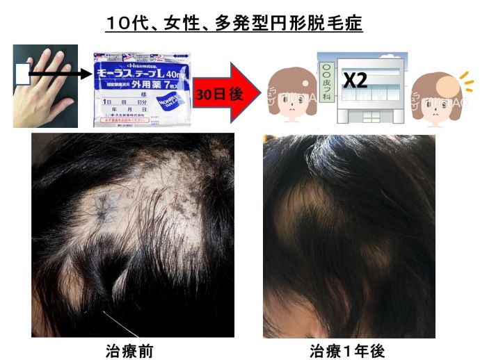 円形脱毛症　病院